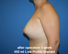 plastic-surgery-breast-augmentation